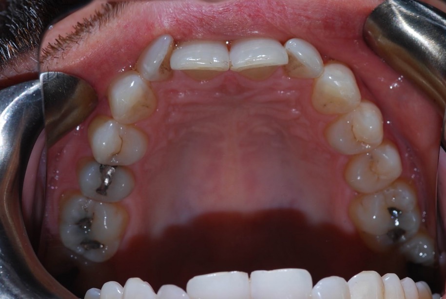 Invisalign before, Wellington patient at Thorndon Dental