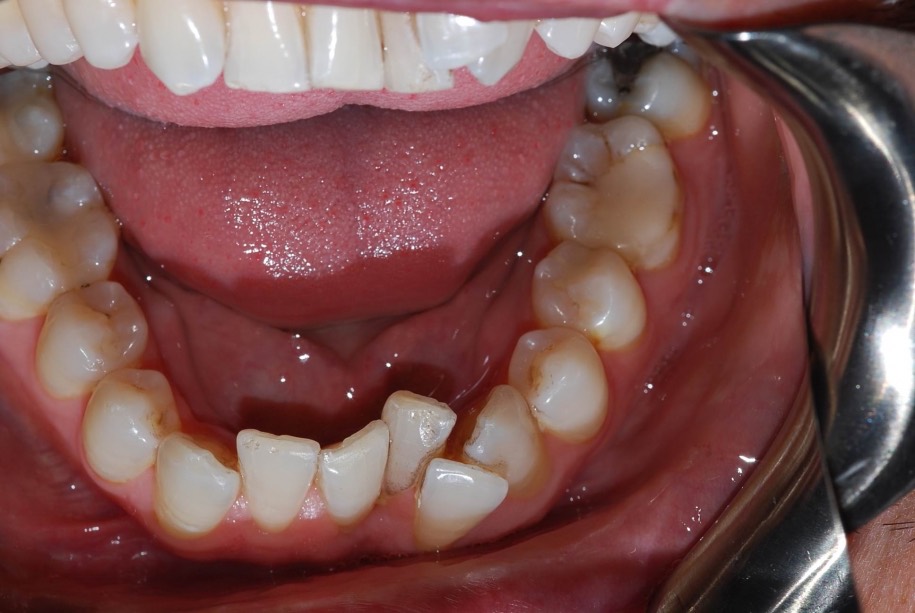 Invisalign before, Wellington patient at Thorndon Dental