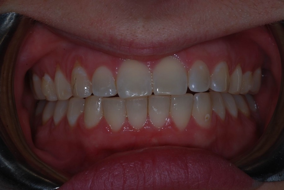 Invisalign after, Wellington patient at Thorndon Dental