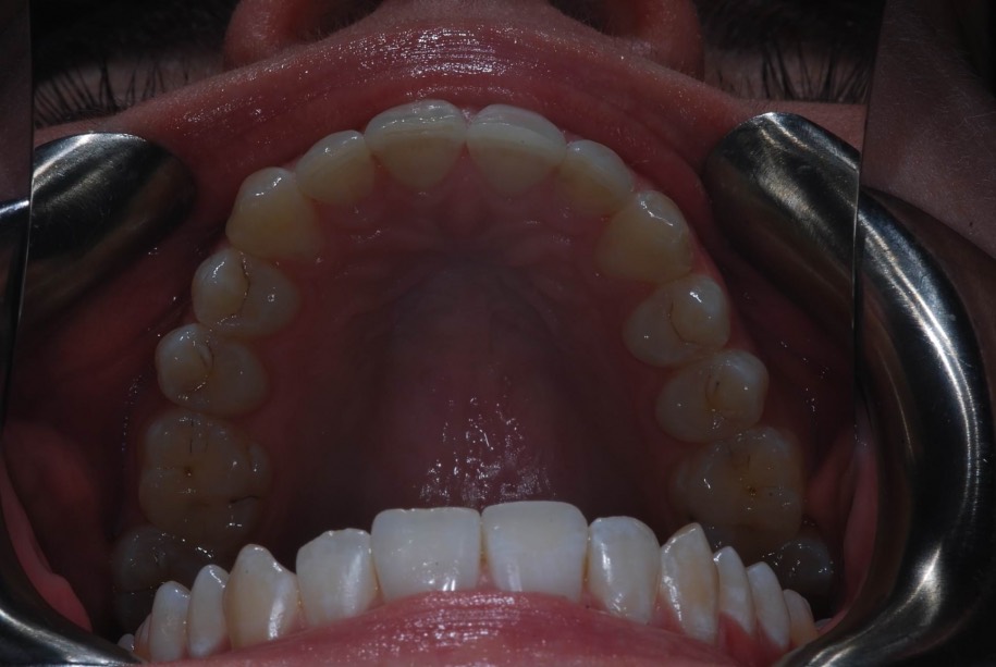 Invisalign after, Wellington patient at Thorndon Dental