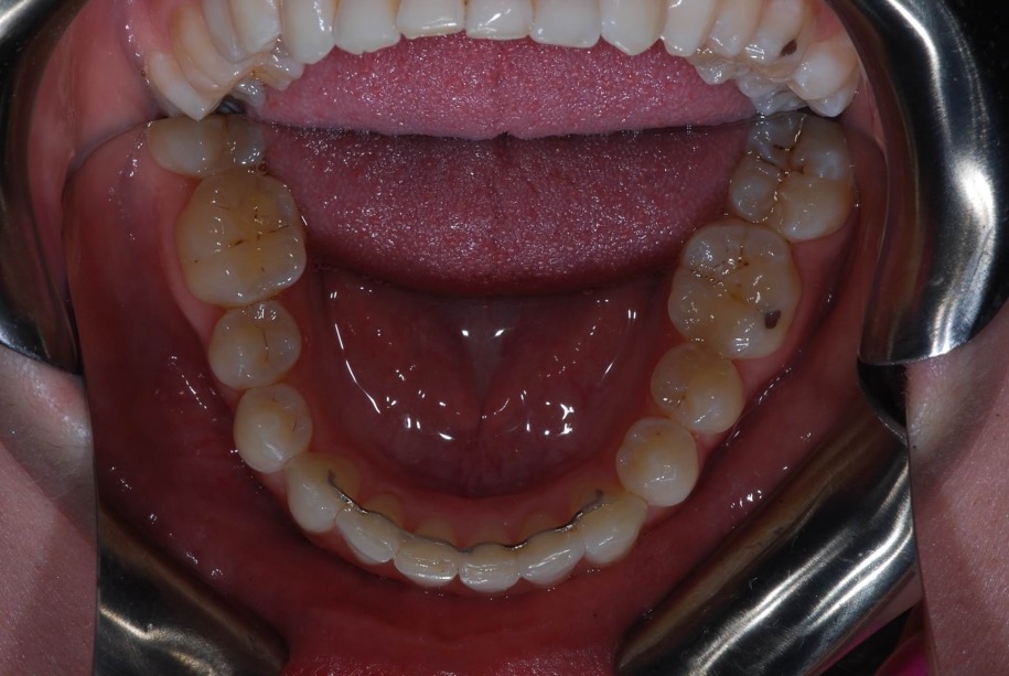 Invisalign after, Wellington patient at Thorndon Dental