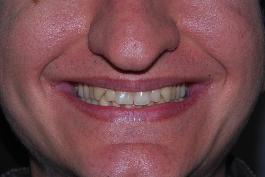 Invisalign before, Wellington patient at Thorndon Dental