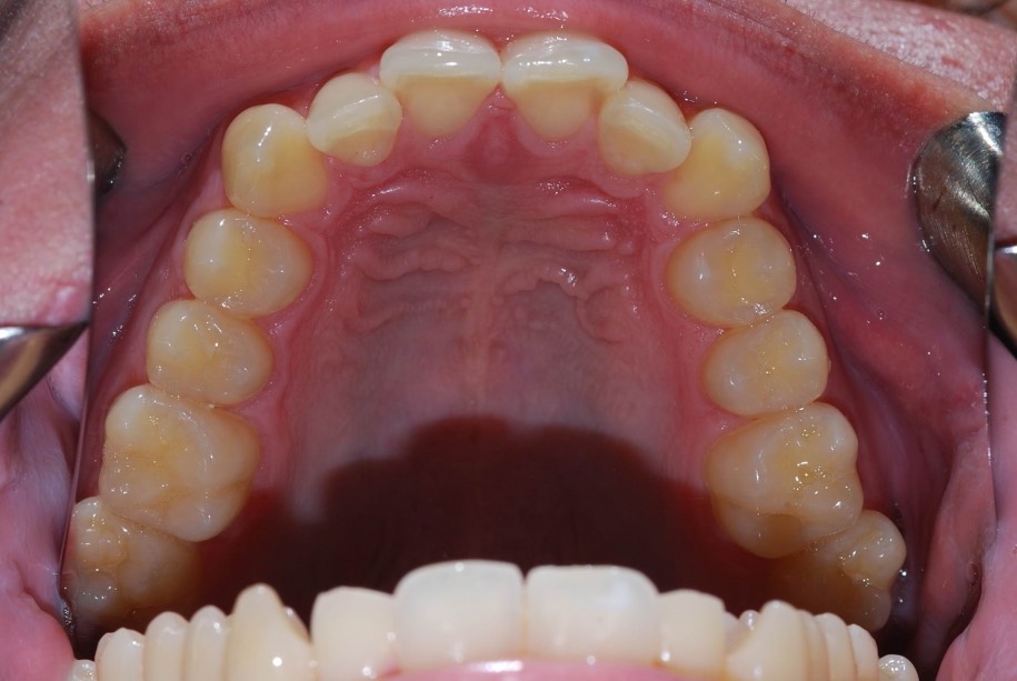 Invisalign before, Wellington patient at Thorndon Dental
