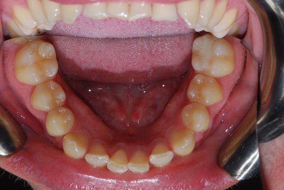 Invisalign before, Wellington patient at Thorndon Dental