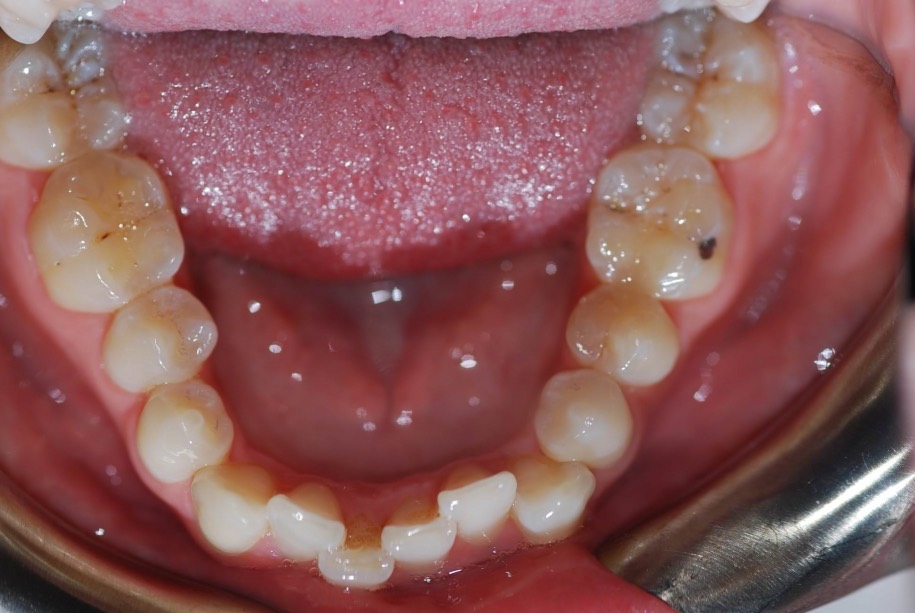 Invisalign before, Wellington patient at Thorndon Dental