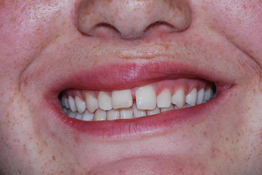 Invisalign before, Wellington patient at Thorndon Dental