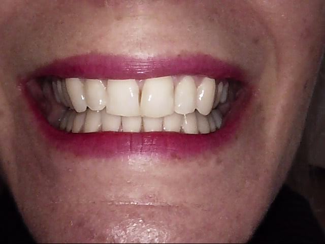 Invisalign after, Wellington patient at Thorndon Dental
