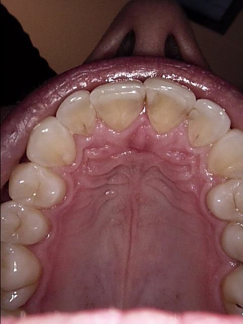 Invisalign after, Wellington patient at Thorndon Dental