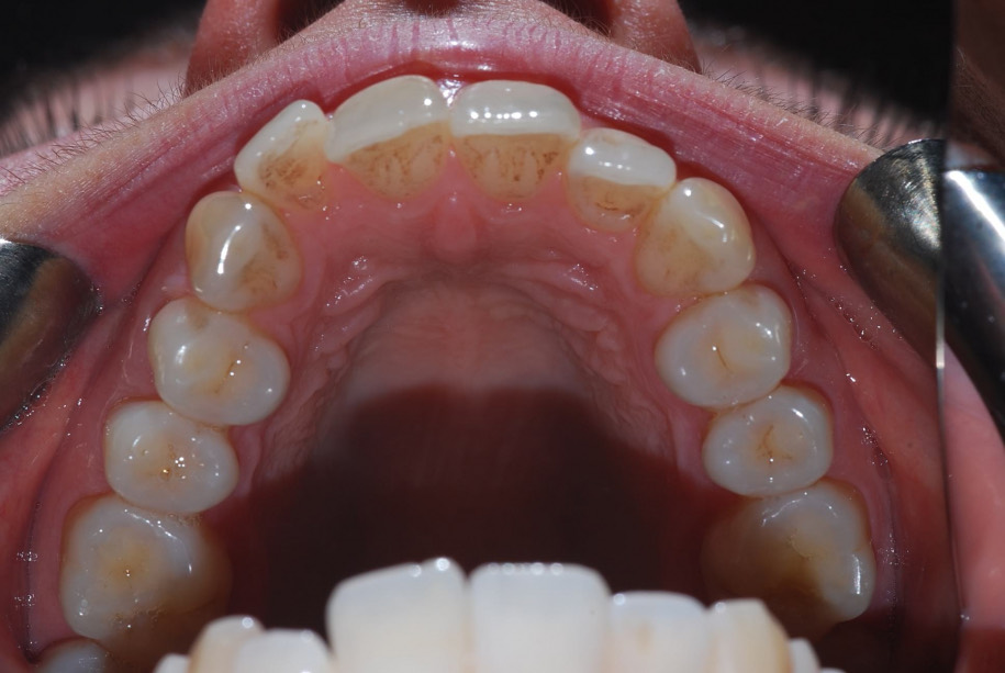 Invisalign before, Wellington patient at Thorndon Dental