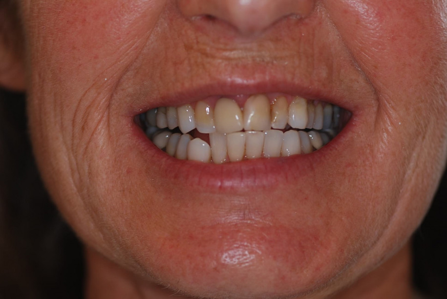 Invisalign before, Wellington patient at Thorndon Dental