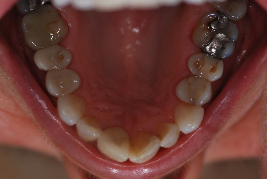 Invisalign before, Wellington patient at Thorndon Dental