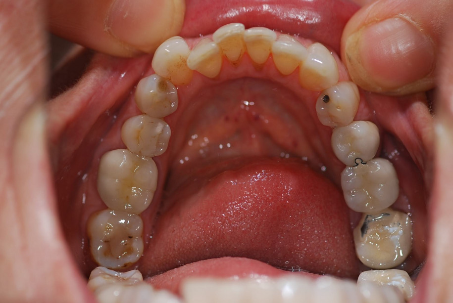 Invisalign before, Wellington patient at Thorndon Dental