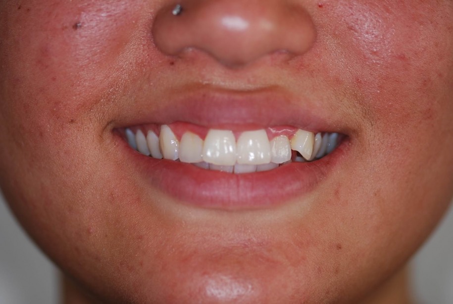Invisalign before, Wellington patient at Thorndon Dental