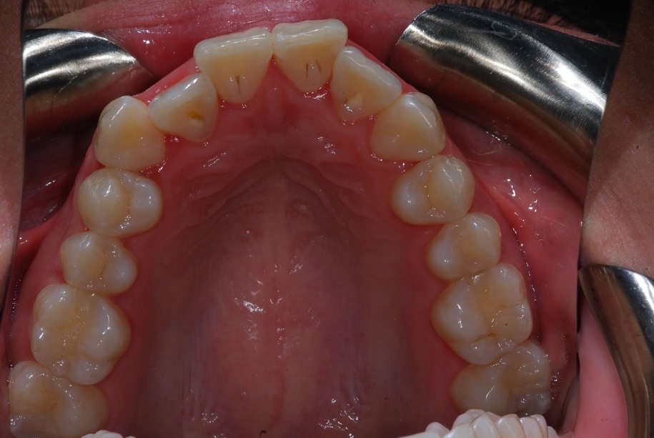 Invisalign before, Wellington patient at Thorndon Dental