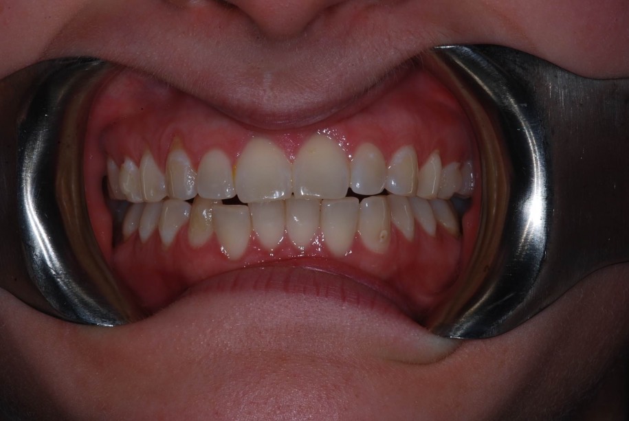 Invisalign before, Wellington patient at Thorndon Dental
