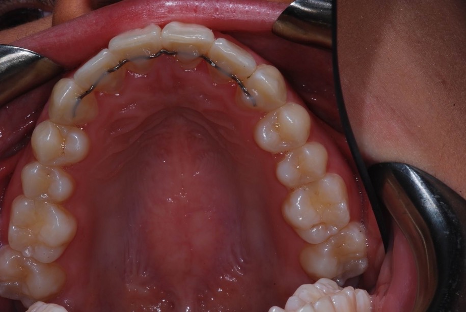Invisalign after, Wellington patient at Thorndon Dental