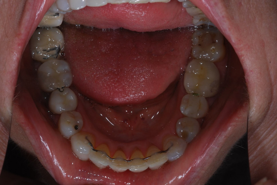 Invisalign after, Wellington patient at Thorndon Dental