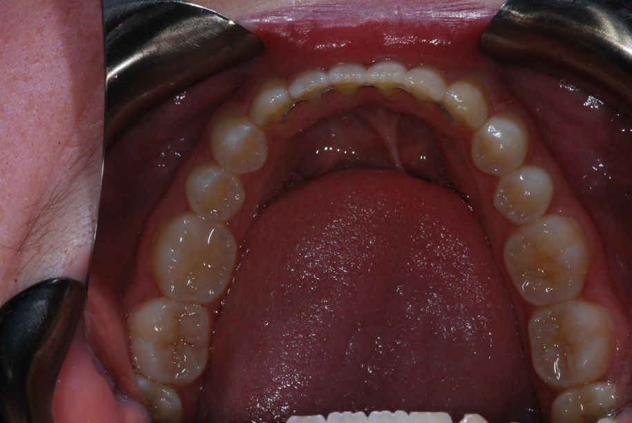 Invisalign after, Wellington patient at Thorndon Dental