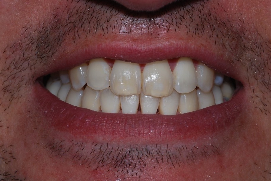 Invisalign after treatment, Wellington patient at Thorndon Dental