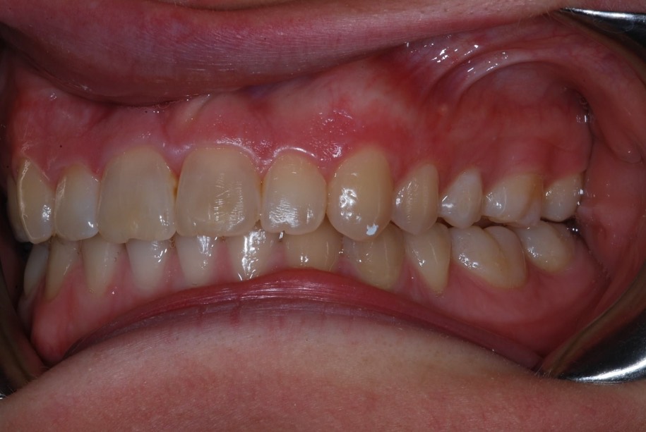 Invisalign after, Wellington patient at Thorndon Dental