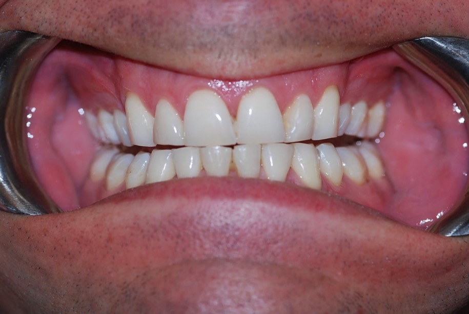 Invisalign after, Wellington patient at Thorndon Dental