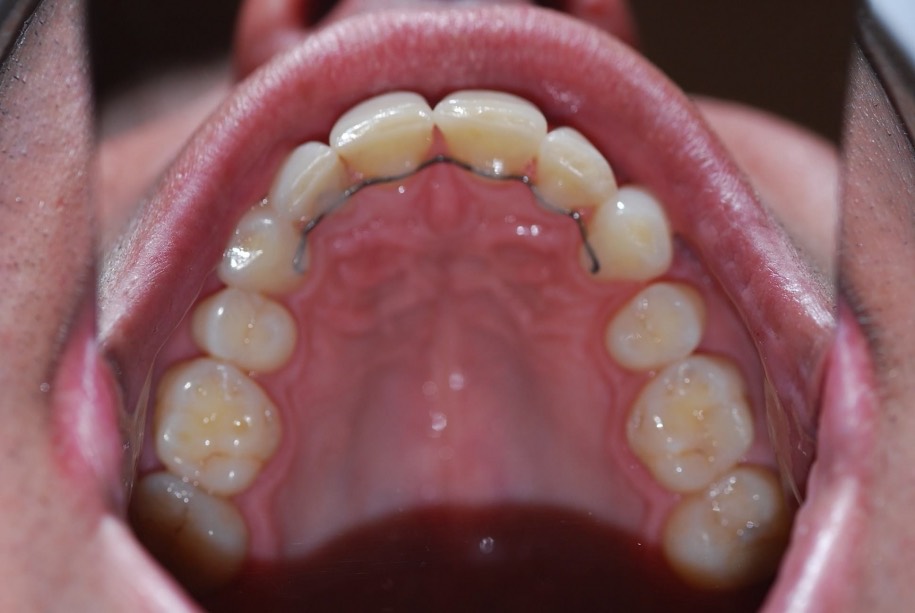 Invisalign after, Wellington patient at Thorndon Dental