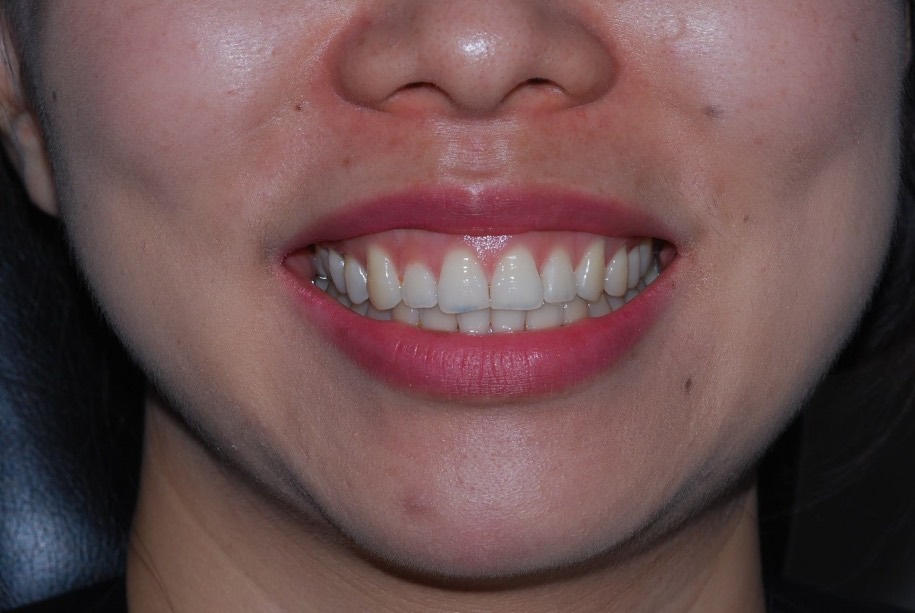 Invisalign after, Wellington patient at Thorndon Dental