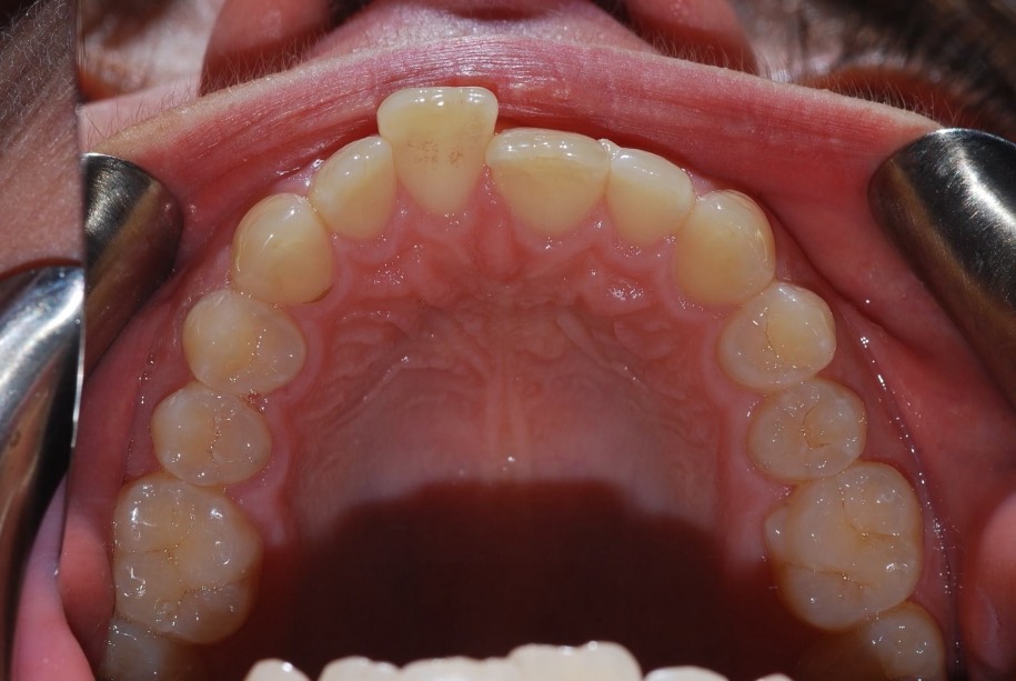 Invisalign before, Wellington patient at Thorndon Dental