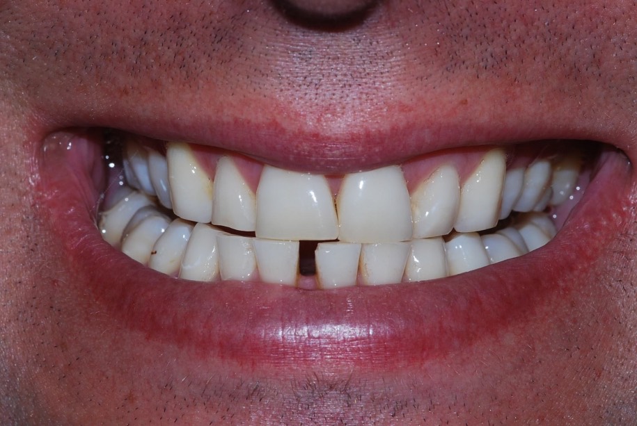 Invisalign before, Wellington patient at Thorndon Dental