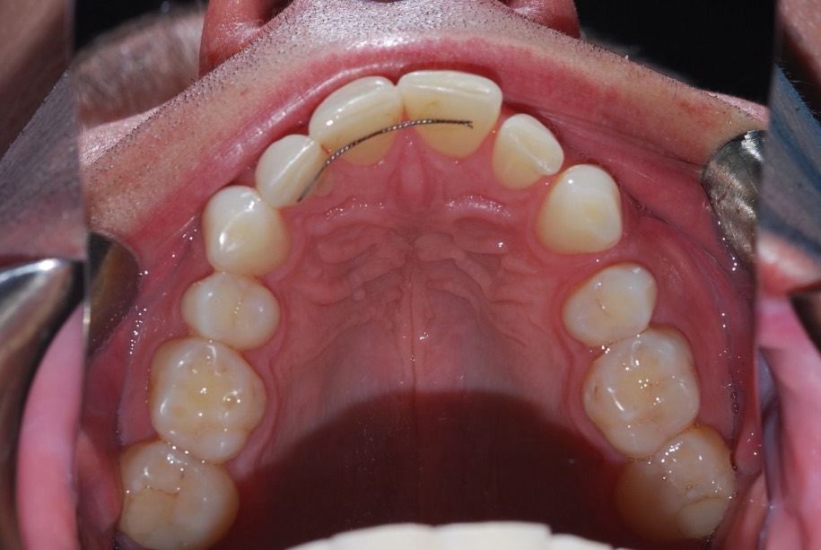 Invisalign before, Wellington patient at Thorndon Dental
