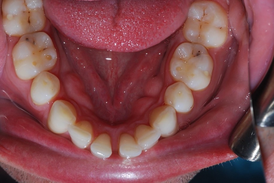 Invisalign before, Wellington patient at Thorndon Dental