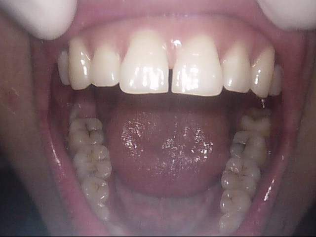 Invisalign before, Wellington patient at Thorndon Dental