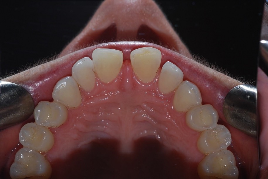 Invisalign before, Wellington patient at Thorndon Dental