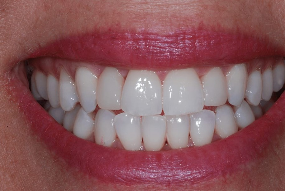 Teeth whitening after treatment, Wellington patient at Thorndon Dental