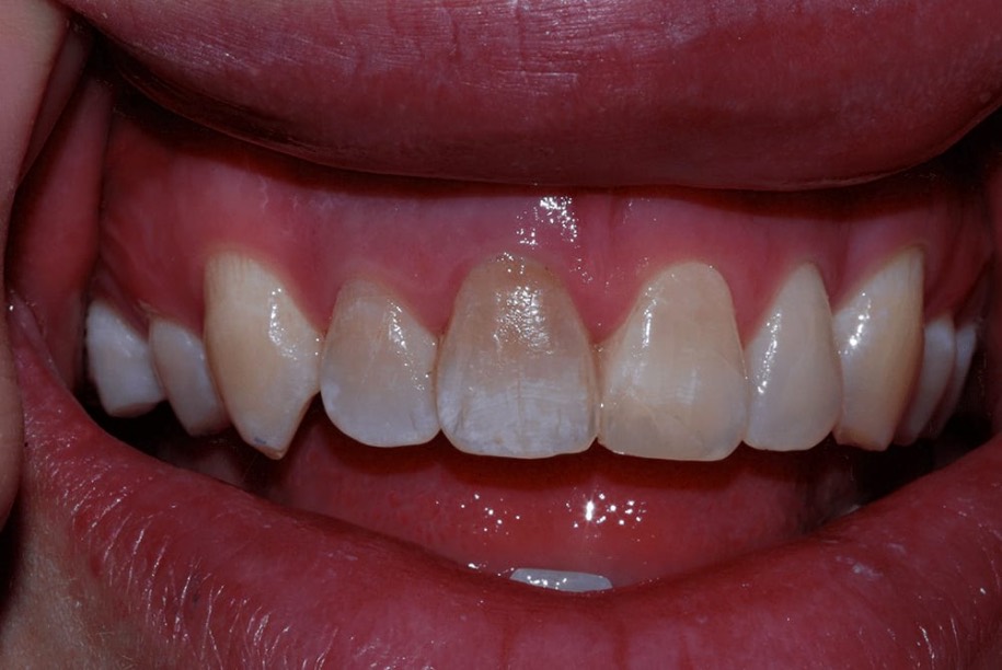 Whitening after, Wellington patient at Thorndon Dental
