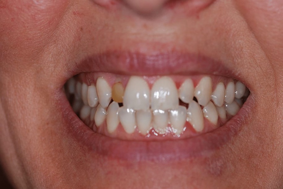 Whitening before, Wellington patient at Thorndon Dental
