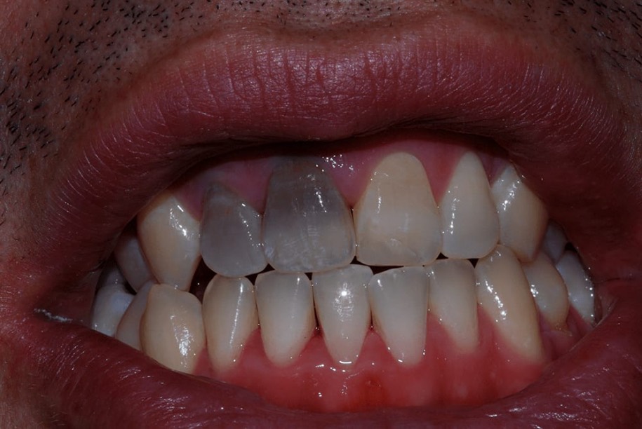 Whitening before, Wellington patient at Thorndon Dental