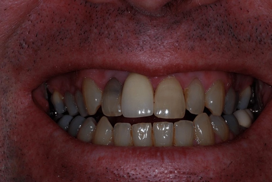 Teeth whitening before, Wellington patient at Thorndon Dental
