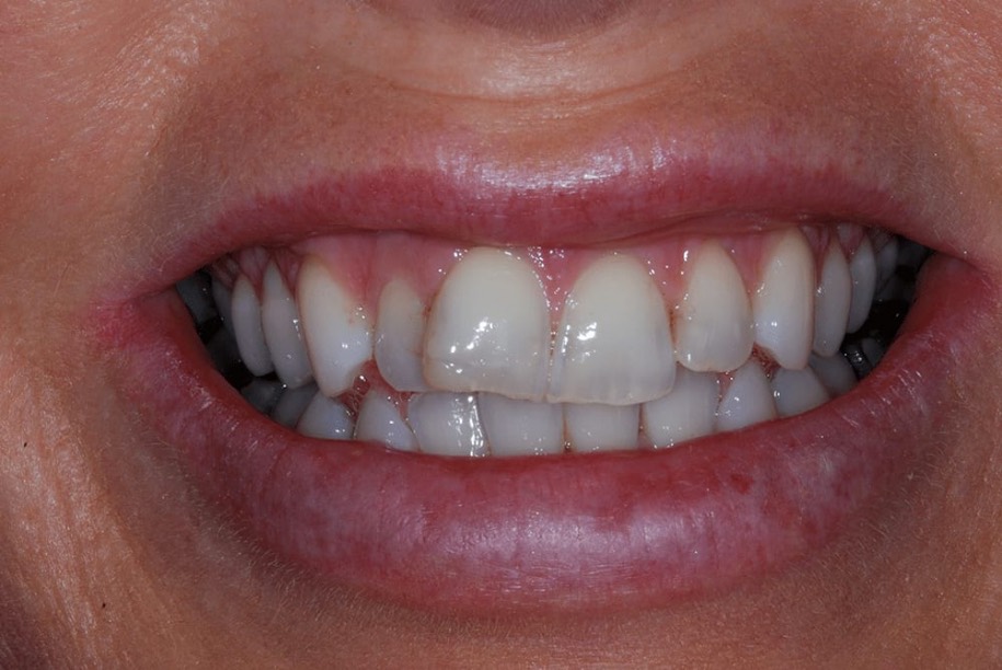 Composite veneers before, Wellington patient at Thorndon Dental