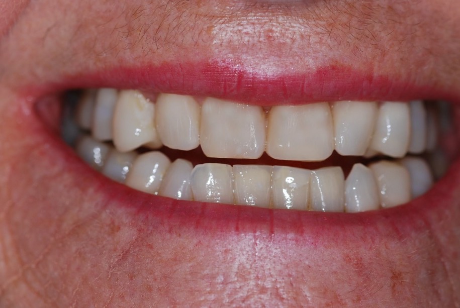 Composite veneers after treatment, Wellington patient at Thorndon Dental