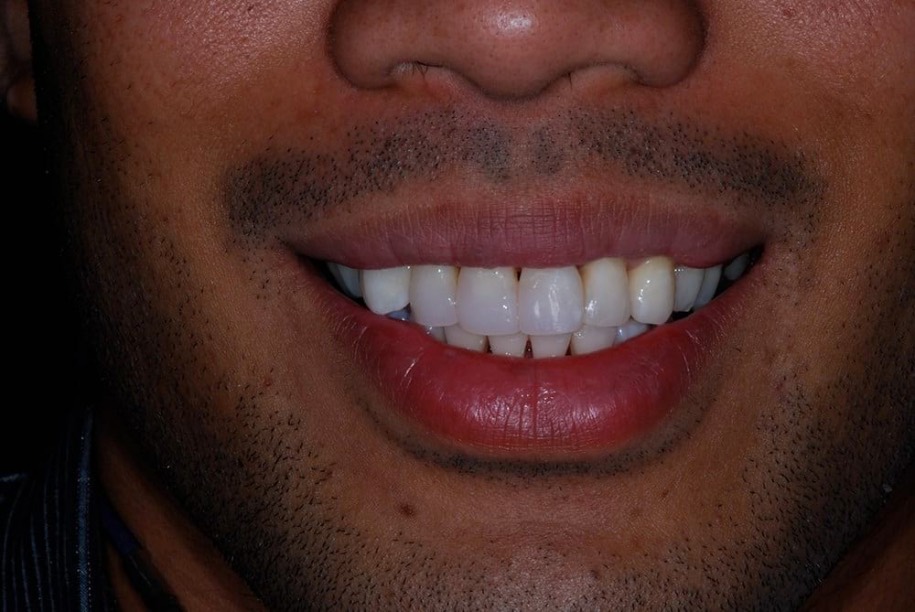 Composite veneers after, Wellington patient at Thorndon Dental