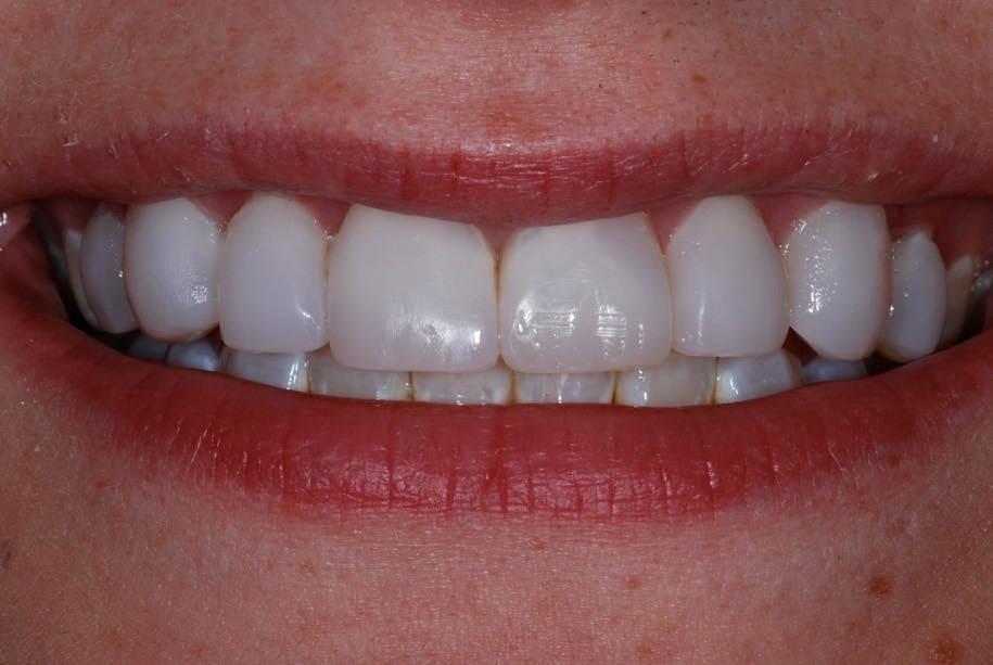 Composite veneers after, Wellington patient at Thorndon Dental