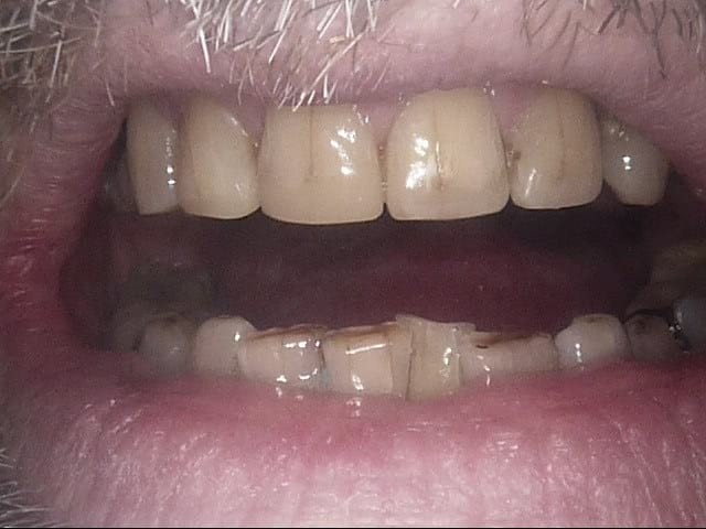 Composite veneers after, Wellington patient at Thorndon Dental