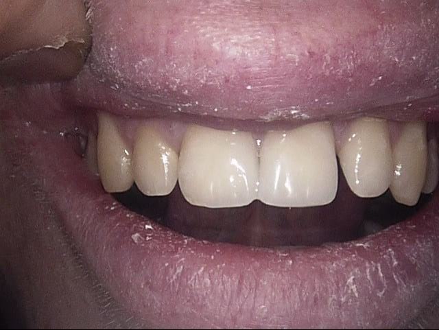 Composite veneers after, Wellington patient at Thorndon Dental