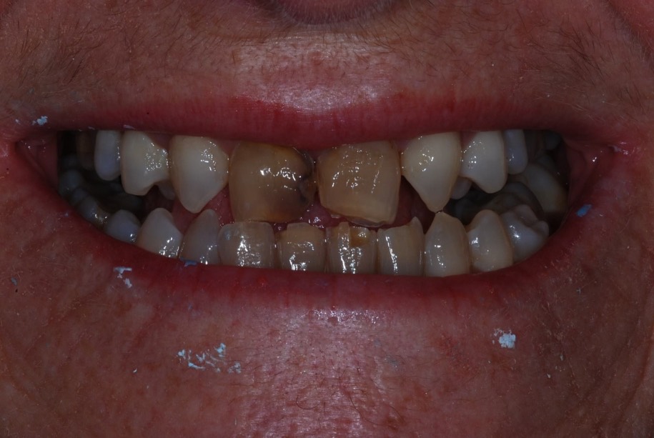 Composite veneers before, Wellington patient at Thorndon Dental