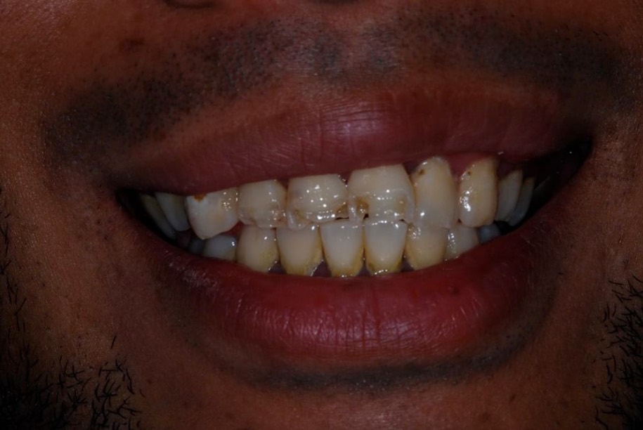 Composite veneers before, Wellington patient at Thorndon Dental