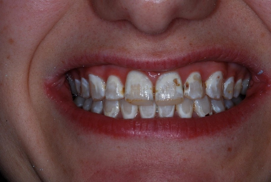 Composite veneers before, Wellington patient at Thorndon Dental