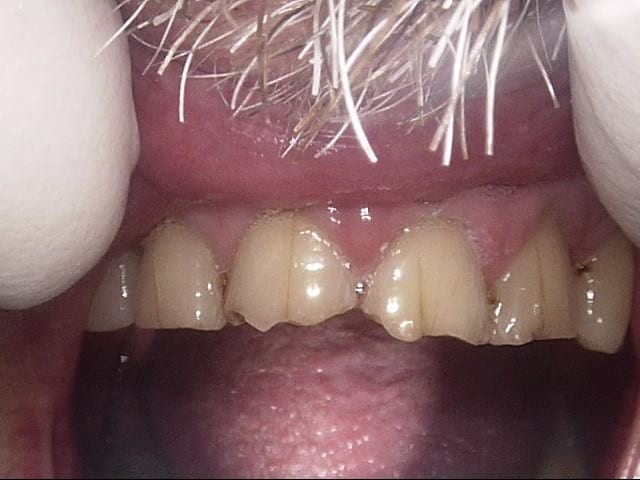 Composite veneers before, Wellington patient at Thorndon Dental