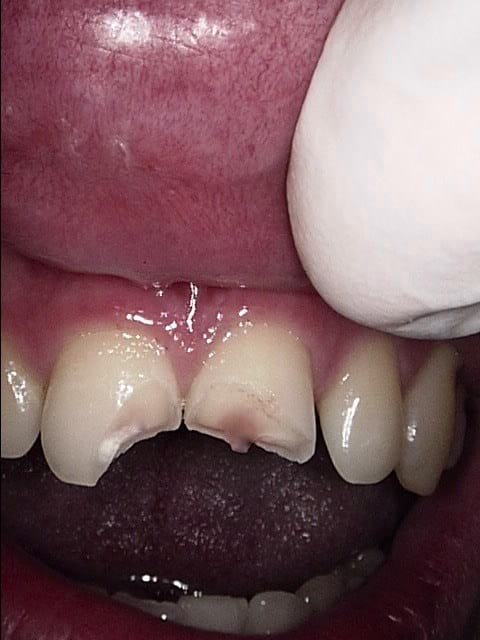 Composite veneers before, Wellington patient at Thorndon Dental