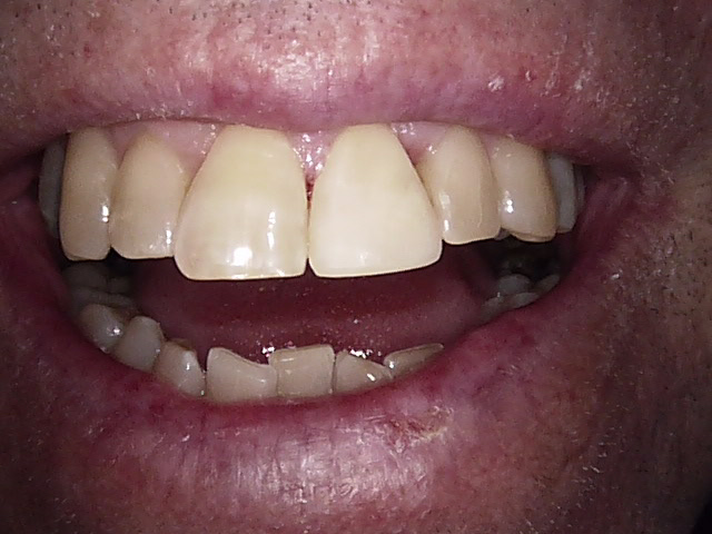 Composite veneers after, Wellington patient at Thorndon Dental
